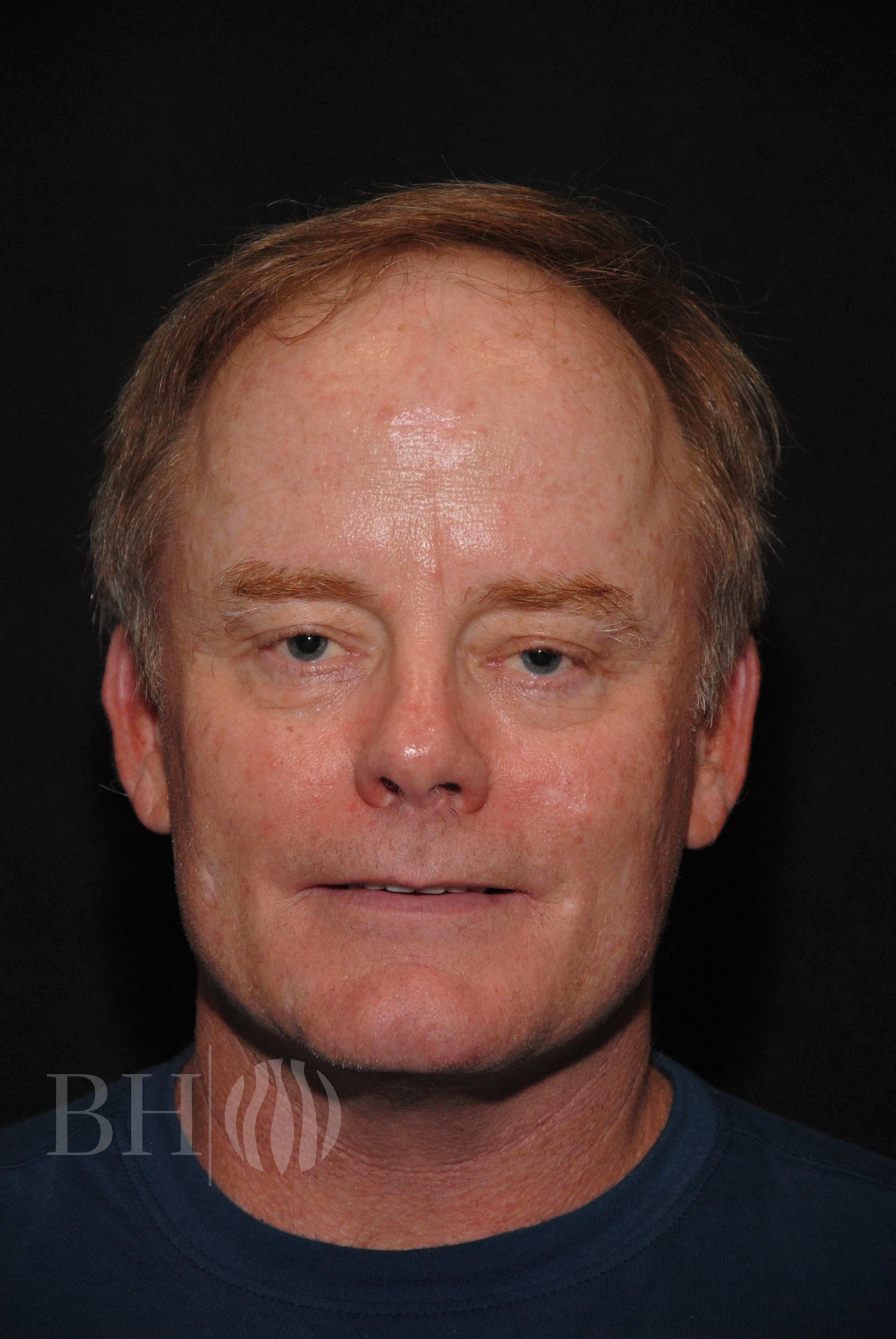 Neograft Hair Restoration Before & After